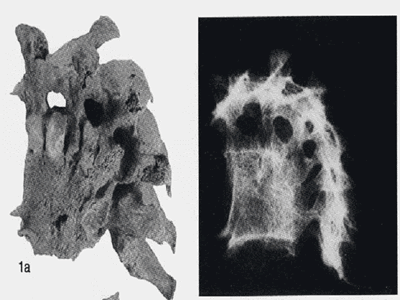 図3　日本最古の結核症例の写真（鳥取県教育文化財団調査報告書より）
