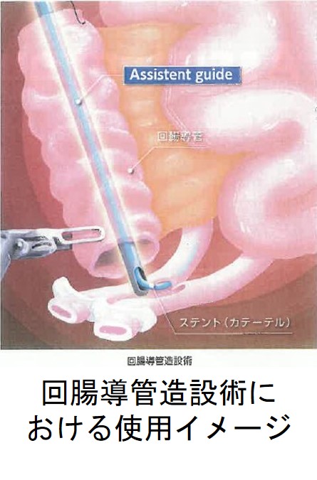 回腸導管造設術における使用イメージ