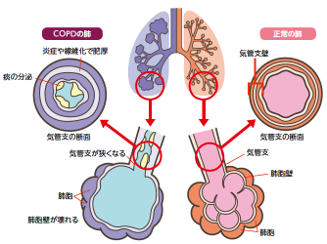 COPDの肺と正常の肺